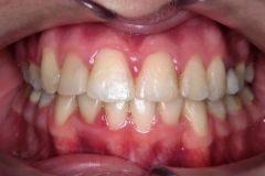 inghesuire dentara 3